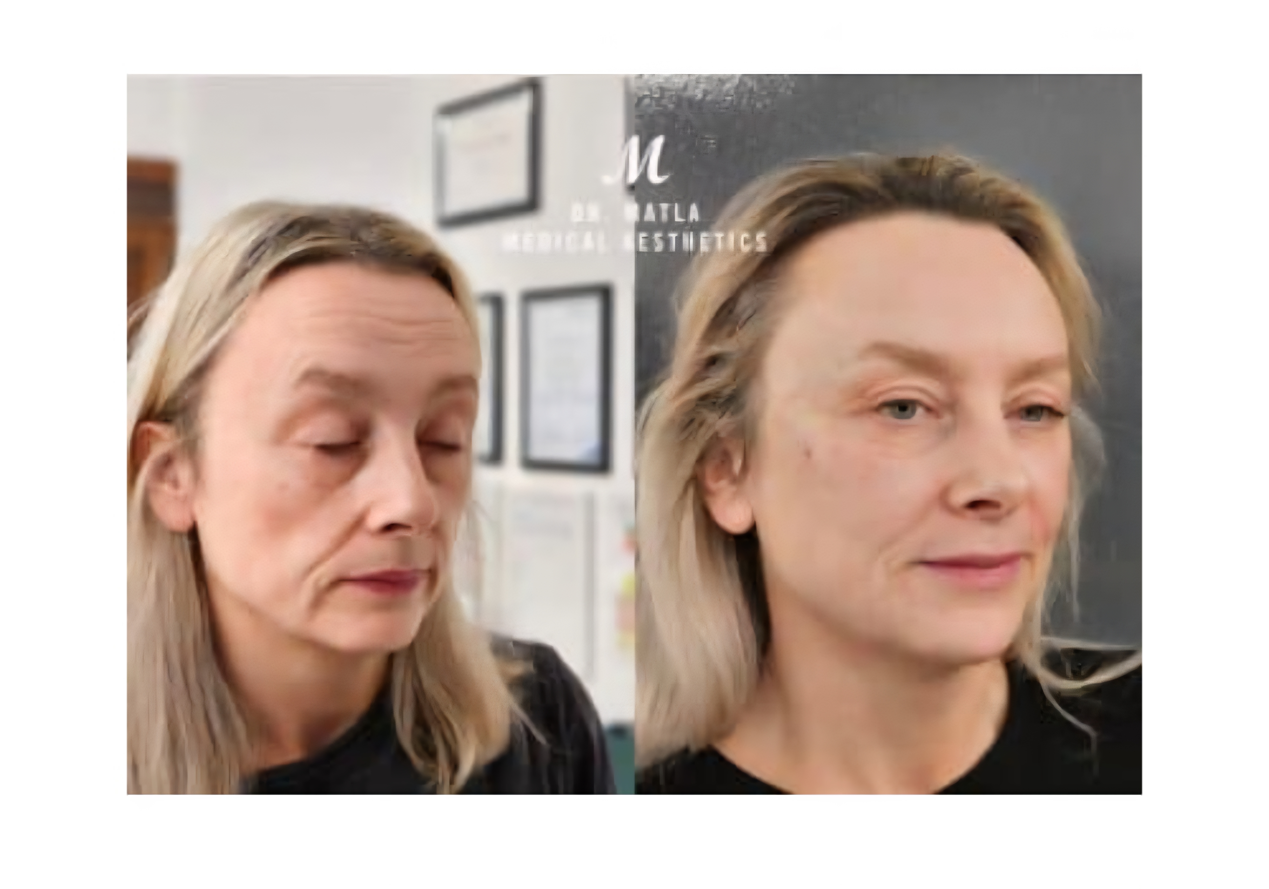 Treatment result
